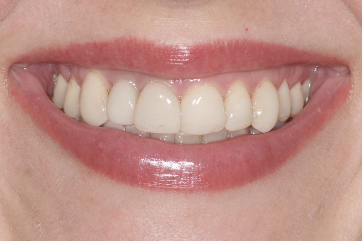 After image