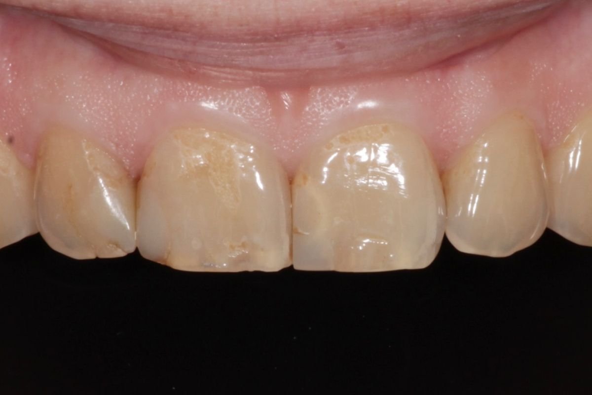 After image