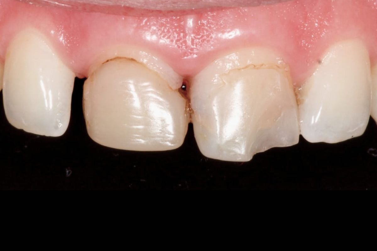 After image