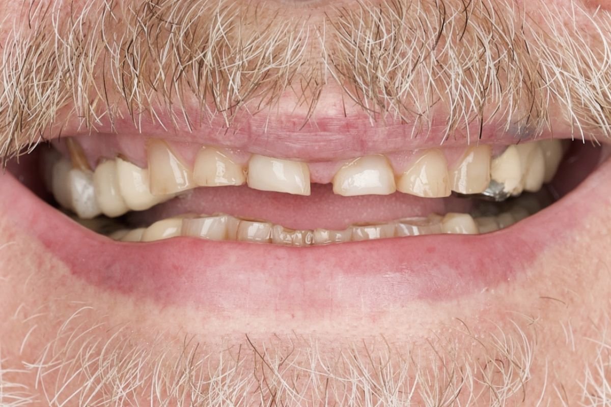 After image