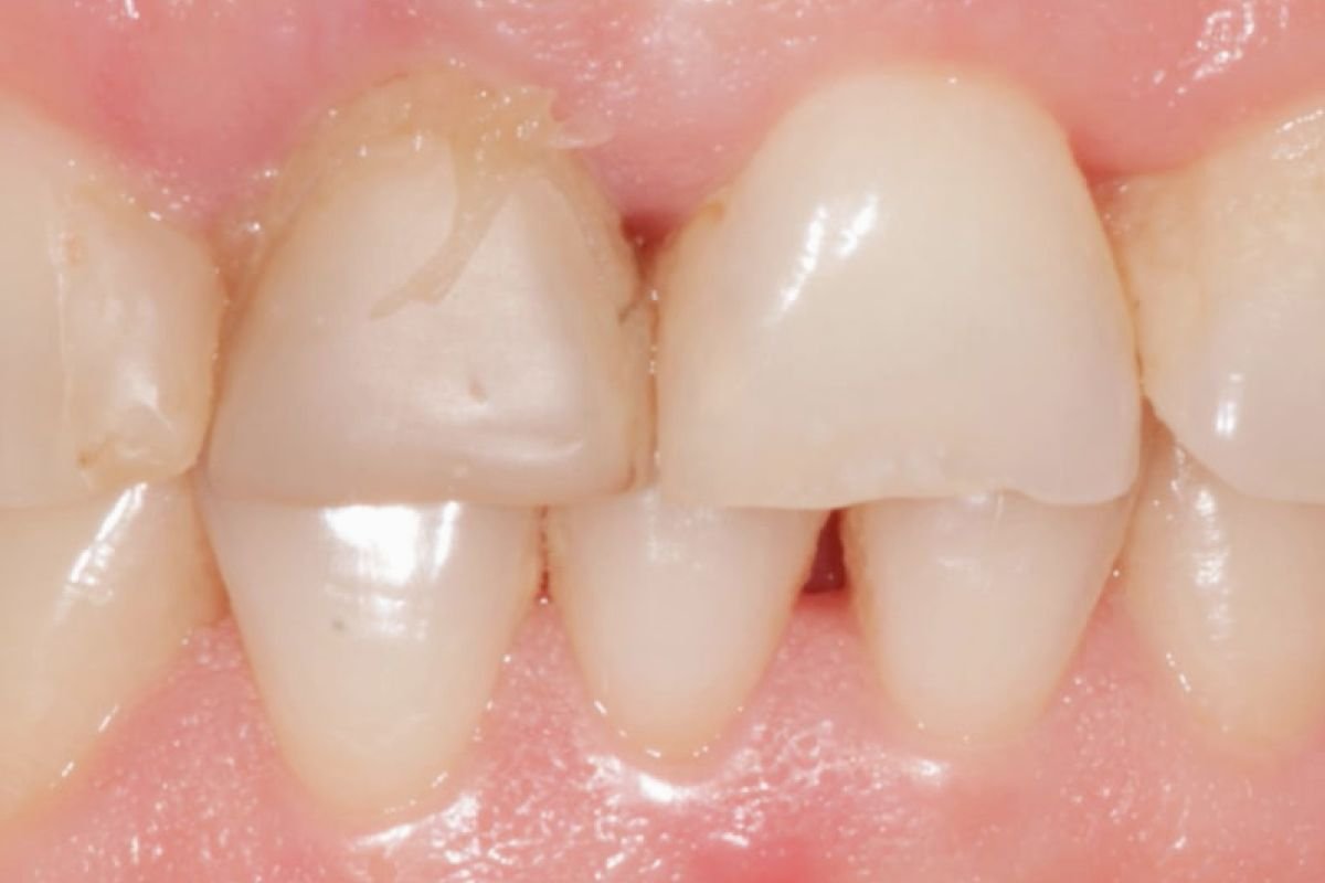 After image